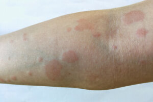 Medical Cannabis For Lupus: Can It Help Manage Symptoms and Summer Flare-Ups?